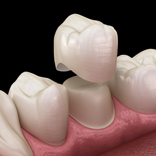 An illustration of a dental crown being placed over a reshaped tooth 