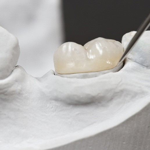 Dentist mocking up a dental crown on a plaster model 