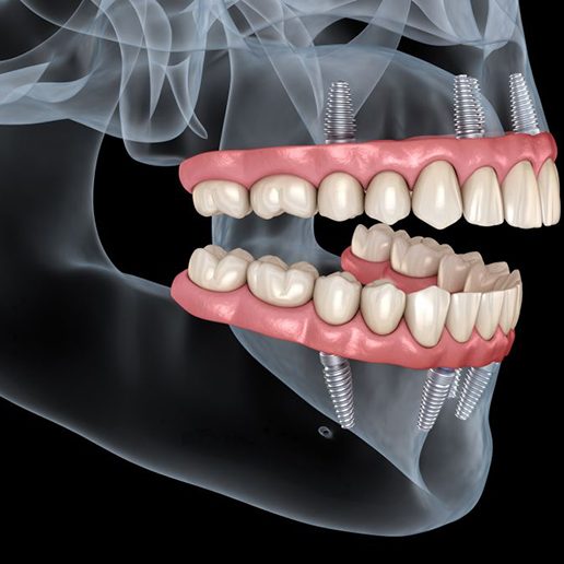 Illustration of All-on-4 dental implants in upper and lower arches