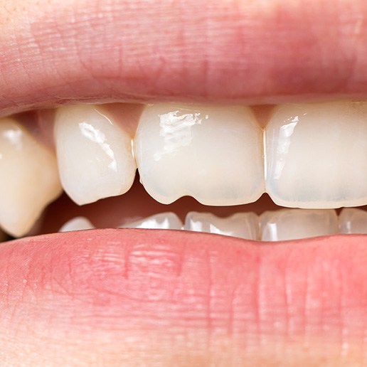 a close-up of a person with a chipped tooth