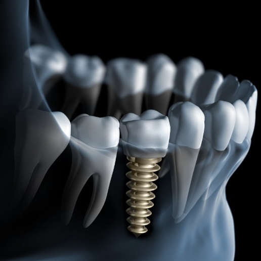 Animated X ray of a person with a dental implant