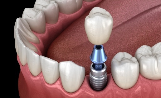 Animated dental implant with crown replacing a missing tooth