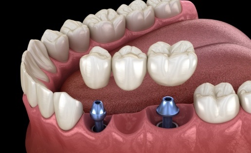 Two animated dental implants with dental bridge replacing three missing teeth