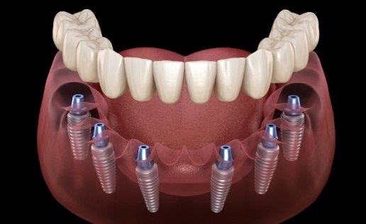 Six animated dental implants supporting a full implant denture