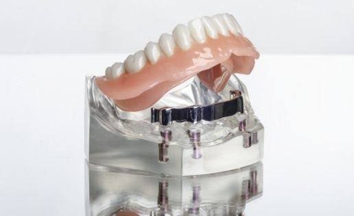 Model of an All on 4 implant denture