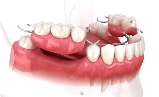 Partial denture