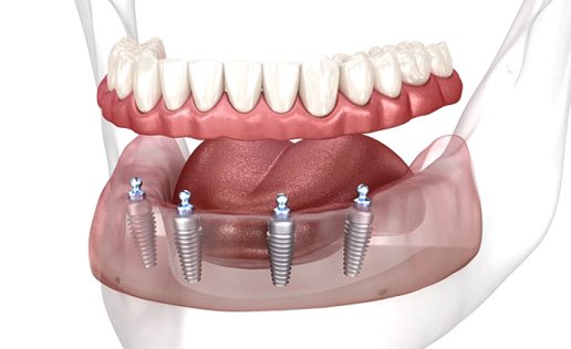 Implant dentures