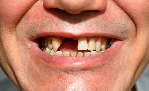 Man smiling to reveal missing teeth
