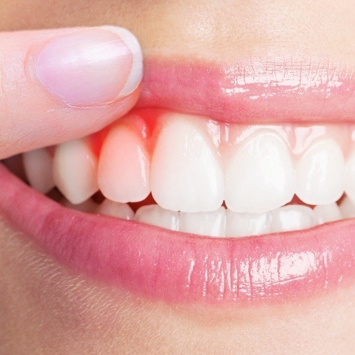 Close up of person pointing to their red gums