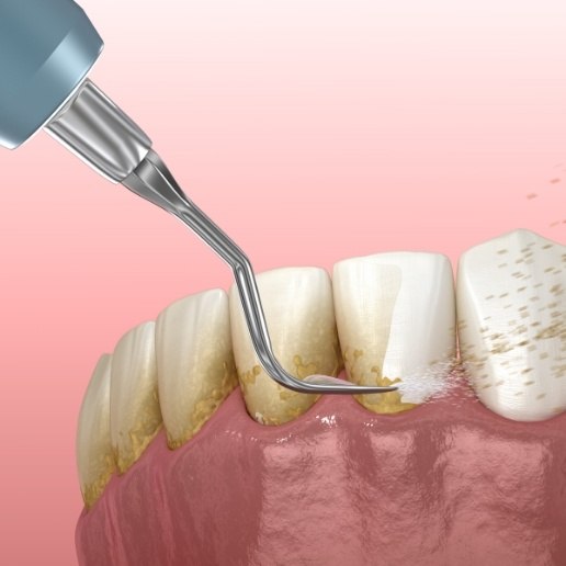 Animated dental tool removing plaque from teeth