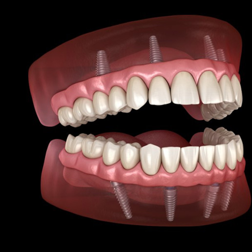 Illustration of implant dentures anchored in gum tissue