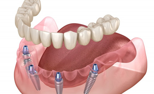 Exploded illustration of removable implant dentures