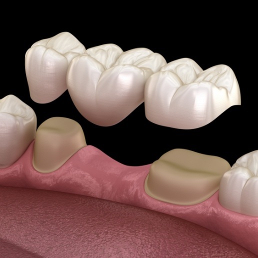 Animated dental bridge replacing a missing tooth