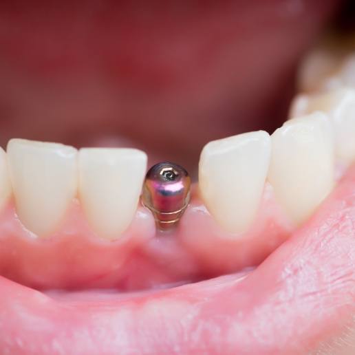 Close up of a mouth with a dental implant