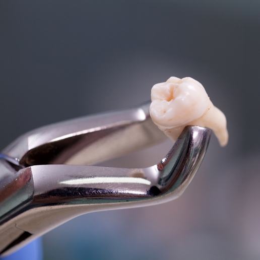 Extracted tooth being held in a pair of dental forceps