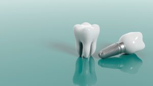 a natural tooth placed next to a dental implant