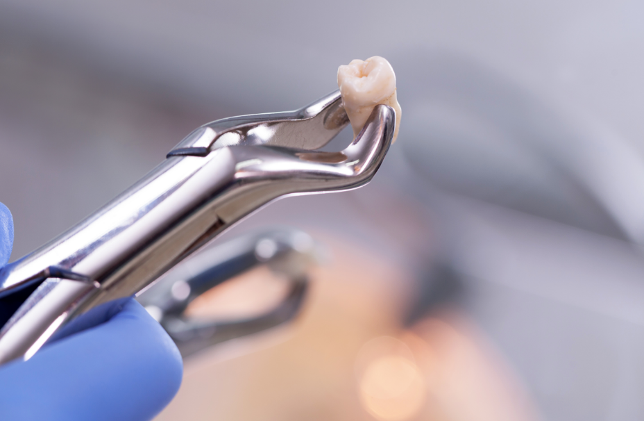 Extracted tooth on forceps