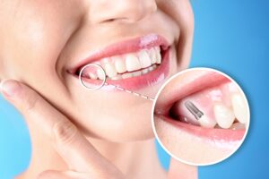 Nose-to-neck closeup of woman touching jaw with thumb and forefinger with one tooth indicated as implant
